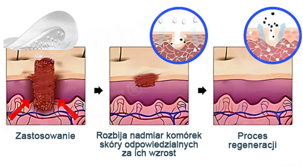 Cvreoz® Nano-Micro Needle Skin Tags Removal Patches