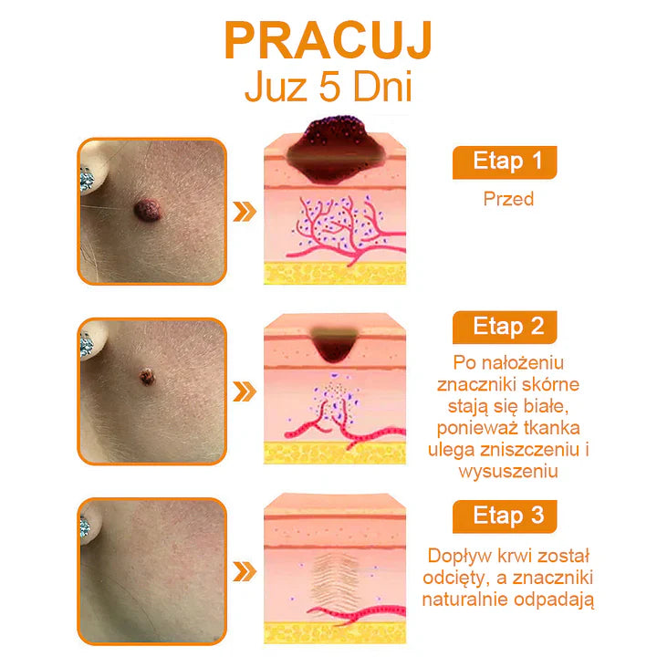 【✨Za pobraniem✨】Vsoxa™ Krem do usuwania brodawek i pieprzyków z jadem pszczelim (👨⚕Zalecenia AAD) 🐝🐝 (🔥Ostatni dzień wyprzedaży 70% taniej)
