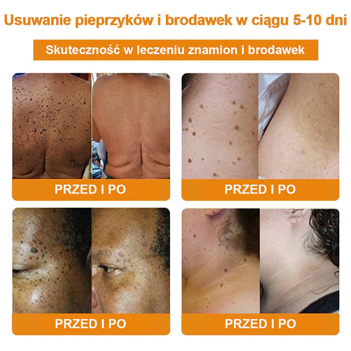 【✨Za pobraniem✨】Vsoxa™ Krem do usuwania brodawek i pieprzyków z jadem pszczelim (👨⚕Zalecenia AAD) 🐝🐝 (🔥Ostatni dzień wyprzedaży 70% taniej)