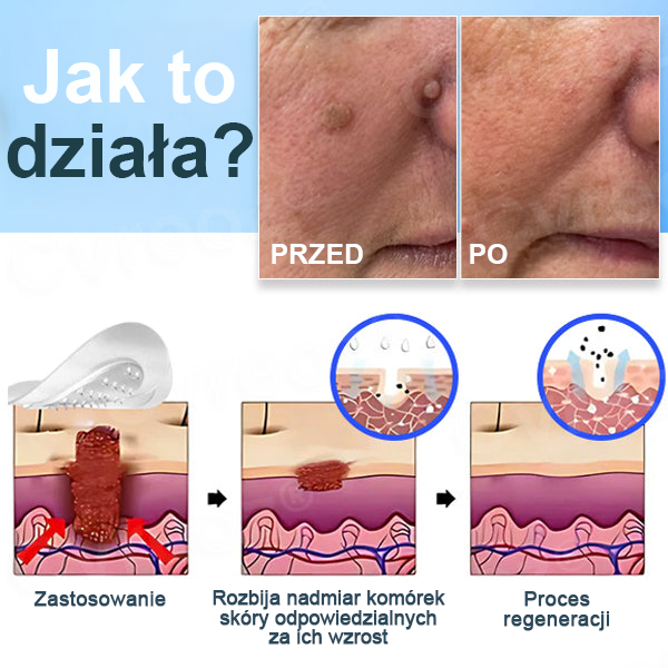 Cvreoz® Nano-Micro Needle Skin Tags Removal Patches