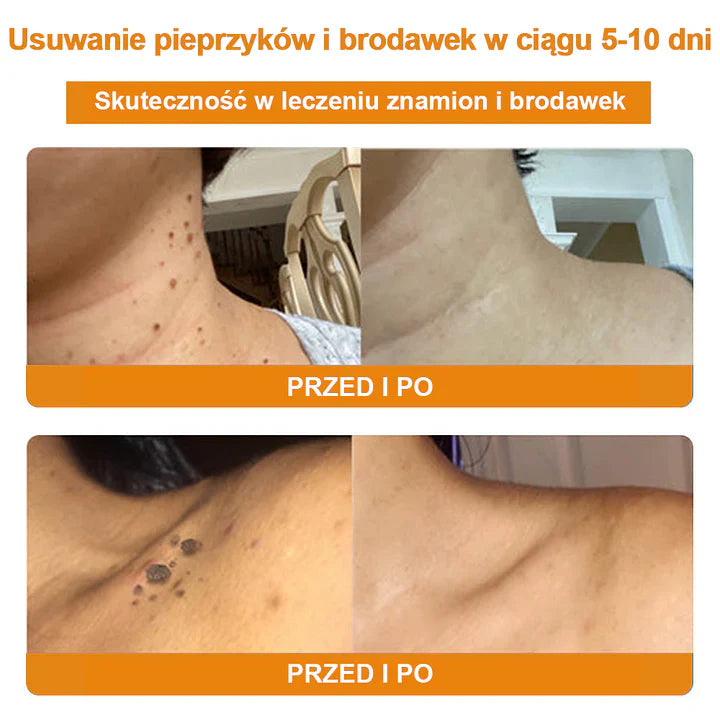 【✨Za pobraniem✨】Vsoxa™ Krem do usuwania brodawek i pieprzyków z jadem pszczelim (👨⚕Zalecenia AAD) 🐝🐝 (🔥Ostatni dzień wyprzedaży 70% taniej)