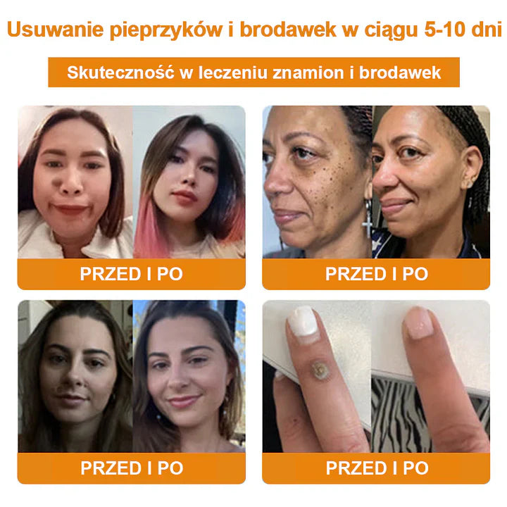 【✨Za pobraniem✨】Vsoxa™ Krem do usuwania brodawek i pieprzyków z jadem pszczelim (👨⚕Zalecenia AAD) 🐝🐝 (🔥Ostatni dzień wyprzedaży 70% taniej)